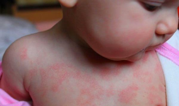 Лечение сыпи на коже после приема антибиотиков у ребенка