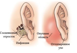 Что из себя представляет отогематома ушной раковины?