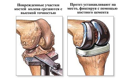 Деформирующий артроз коленного сустава 1 степени