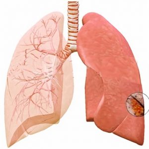 Прогноз при гангрене лёгкого: методы лечения
