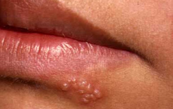 Герпес под губой или над ней: причины и симптомы, а также способы лечения