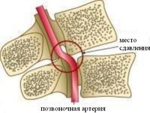 Лечение синдрома позвоночной артерии при шейном остеохондрозе