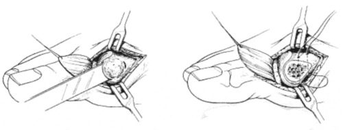 Особенности домашнего лечения косточки на большом пальце ноги