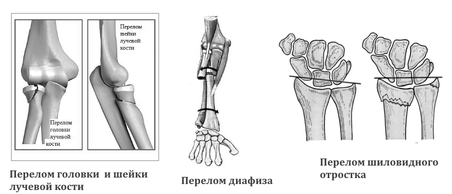 Виды перелома лучевой кости и методы лечения
