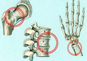 Что такое диффузный остеопороз?