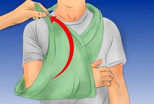 Наложение косынки для поддержания руки при переломе