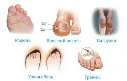Причины боли в большом пальце ноги и способы ее устранения