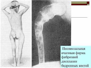 Фиброзная остеодисплазия бедренной кости: классификация, признаки, диагностика, лечение и последствия