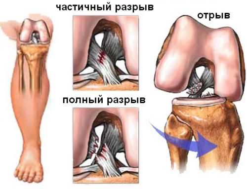 Симптомы дегенеративного повреждения менисков колена