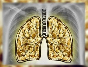 Признаки и симптомы попкорновой болезни лёгких