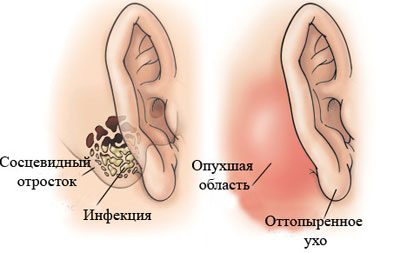 Особенности лечения ушиба уха