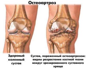 От чего болят суставы в коленях у молодых женщин: причины и лечение