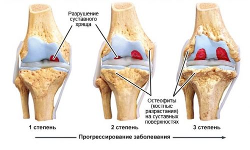 Особенности лечения острого артроза коленного сустава