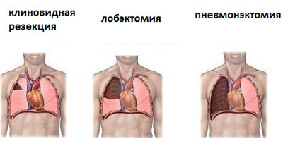 Туберкулема лёгких – диагностика и лечение