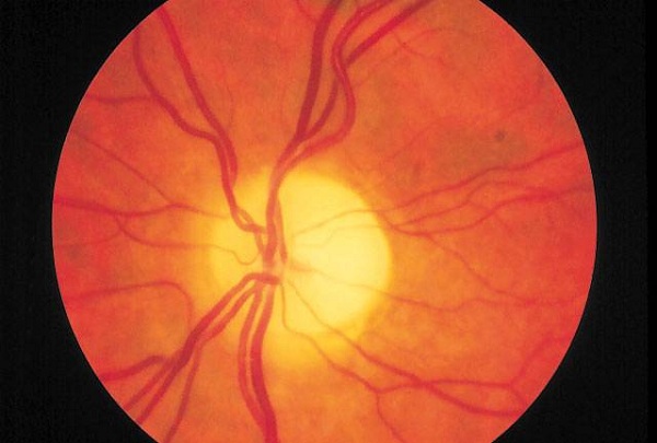 Атрофия зрительного нерва: риски и лечение заболевания