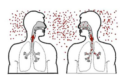 Симптомы туберкулёза внутригрудных лимфоузлов: диагностика и лечение