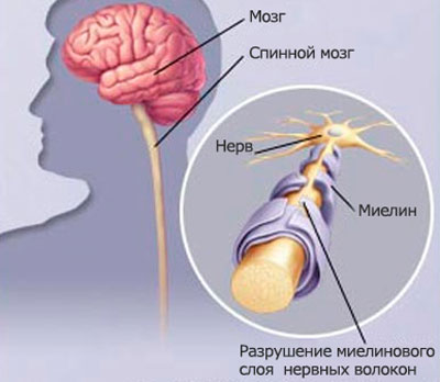 Симптомы и лечение неврита тройничного нерва