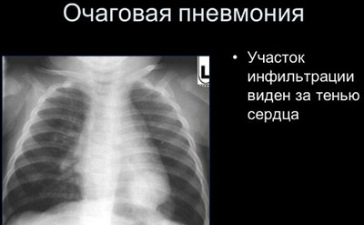 Доктор Комаровский о пневмонии у детей