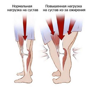 Лечение болей в колене при подъеме и спуске по лестнице
