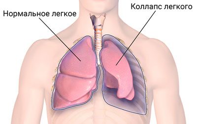 Симптомы и лечение коллапса лёгких