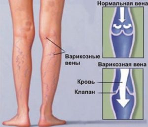 Онемение ноги от бедра до колена с внешней стороны: причины и методы лечения