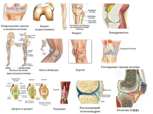 Причины и лечение болей в области колена при сидении