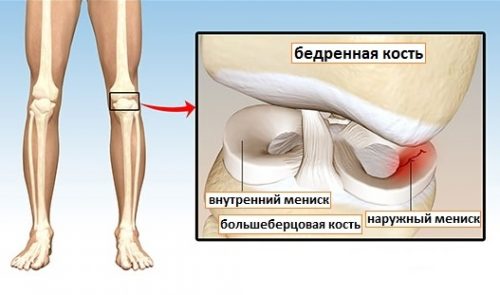 Проявление менисцита коленного сустава и его лечение