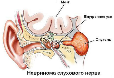Невринома слухового нерва: симптомы, лечение и особенности опухоли