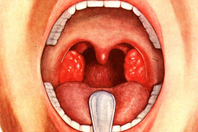 Применение настойки календулы для полоскания горла