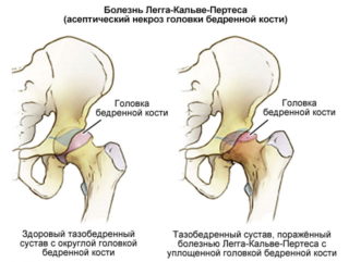 Вальгусная деформация шеек бедренных костей: постановка диагноза, лечение, реабилитация и профилактика