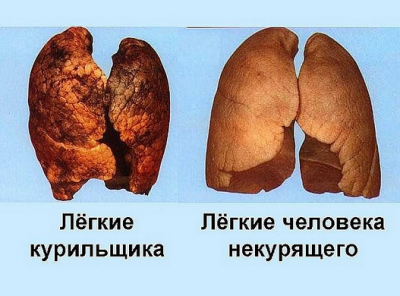 Как выглядят лёгкие курильщика