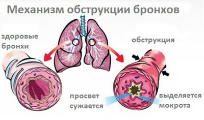 Бронхиальная астма: Комаровский