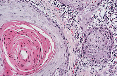 Особенности плоскоклеточного рака лёгких: формы, стадии, лечение и прогноз