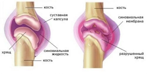 Особенности лечения острого артроза коленного сустава