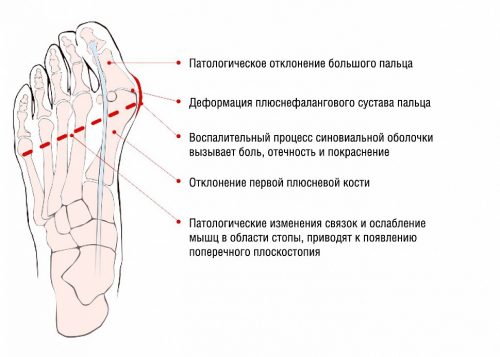 Ортопедический фиксатор для коррекции косточек на ногах
