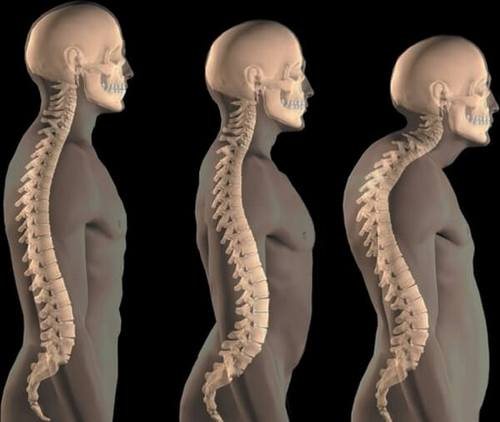 Каковы причины появления горба на спине у человека?