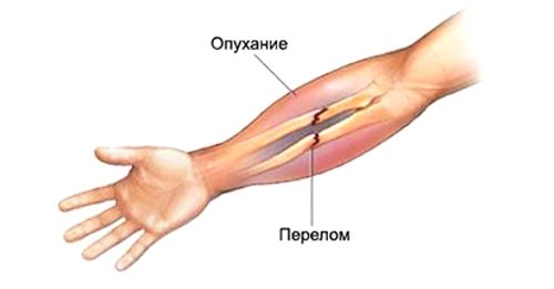 Наложение косынки для поддержания руки при переломе