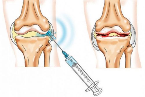 Особенности лечения артрита коленного сустава различных форм
