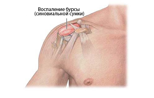 Особенности проявления и лечение бурсита плеча
