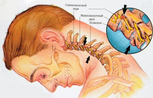 Почему возникают боли в шее после сна и как их устранить?