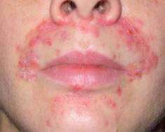 Покраснение в области носа: причины проявления симптома