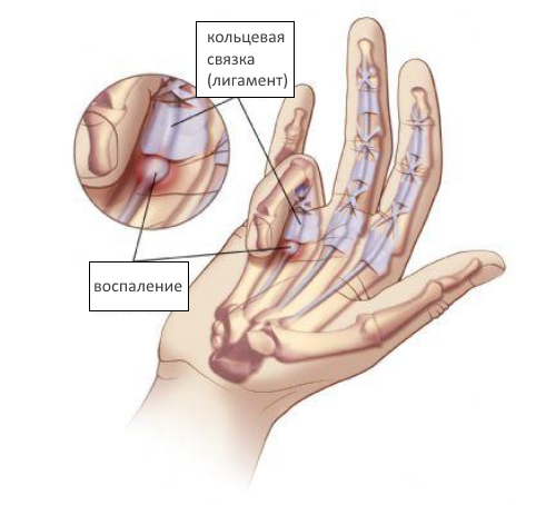 Причины боли в суставах пальцев рук и ее лечение