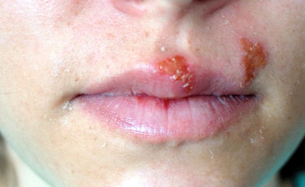 Герпес под губой или над ней: причины и симптомы, а также способы лечения