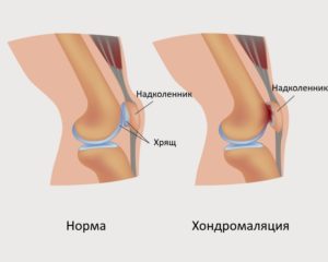От чего болят суставы в коленях у молодых женщин: причины и лечение