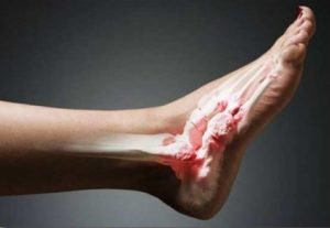 Косточка на ноге сбоку с внешней стороны стопы: причины и лечение