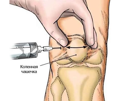 Лечение препателлярного бурсита коленного сустава