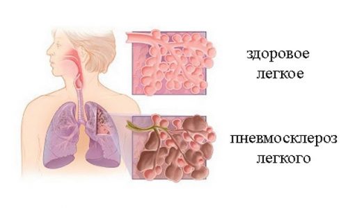 Степени остеохондроза шейного отдела позвоночника