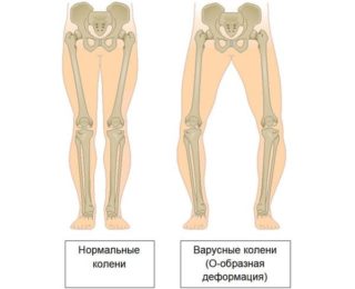 Варусная деформация бедренной кости: причины, классификация, симптомы и лечение