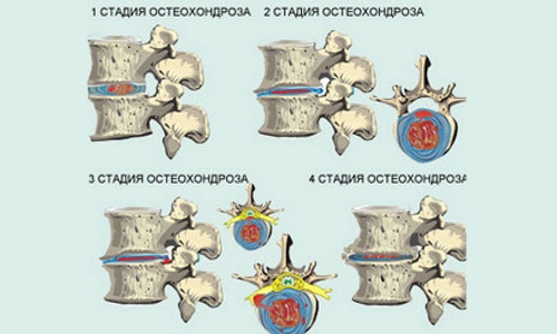Степени остеохондроза шейного отдела позвоночника