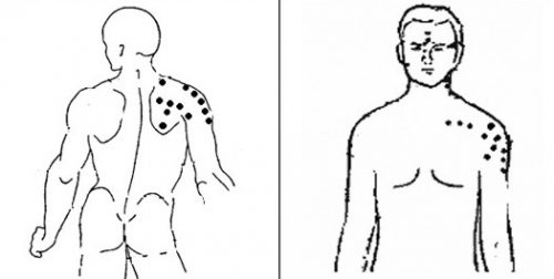 Особенности проявления и лечение бурсита плеча